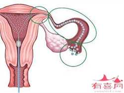 上海可选性别包成功，宫腔镜后提重物的危害有哪些？宫腔镜后可以提重物吗